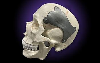 A human skull model wearing a trauma fixation hardware